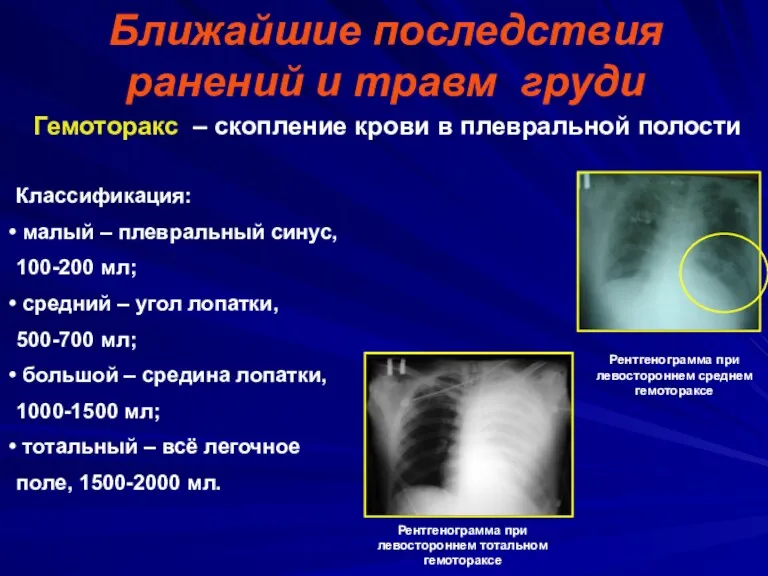 Ближайшие последствия ранений и травм груди Гемоторакс – скопление крови