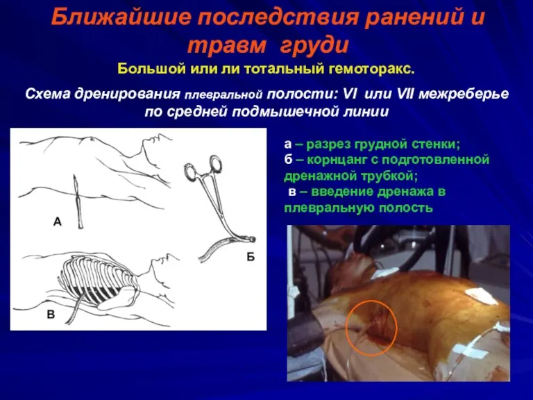 Ближайшие последствия ранений и травм груди Большой или ли тотальный
