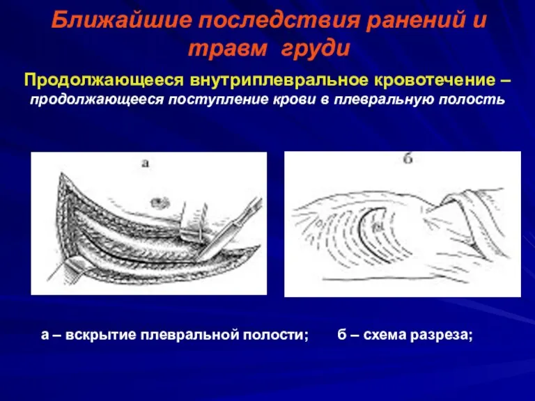 Ближайшие последствия ранений и травм груди Продолжающееся внутриплевральное кровотечение –