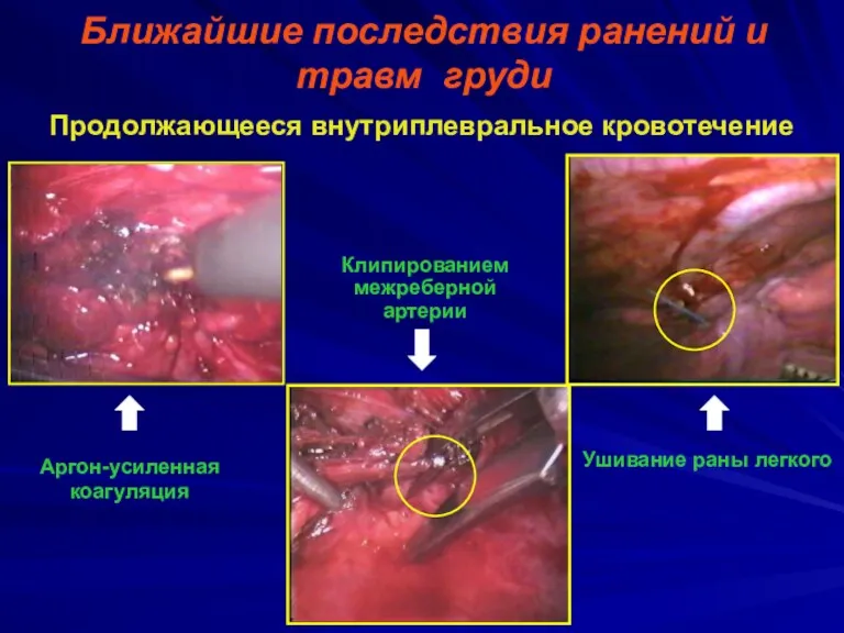 Ближайшие последствия ранений и травм груди Продолжающееся внутриплевральное кровотечение Ушивание
