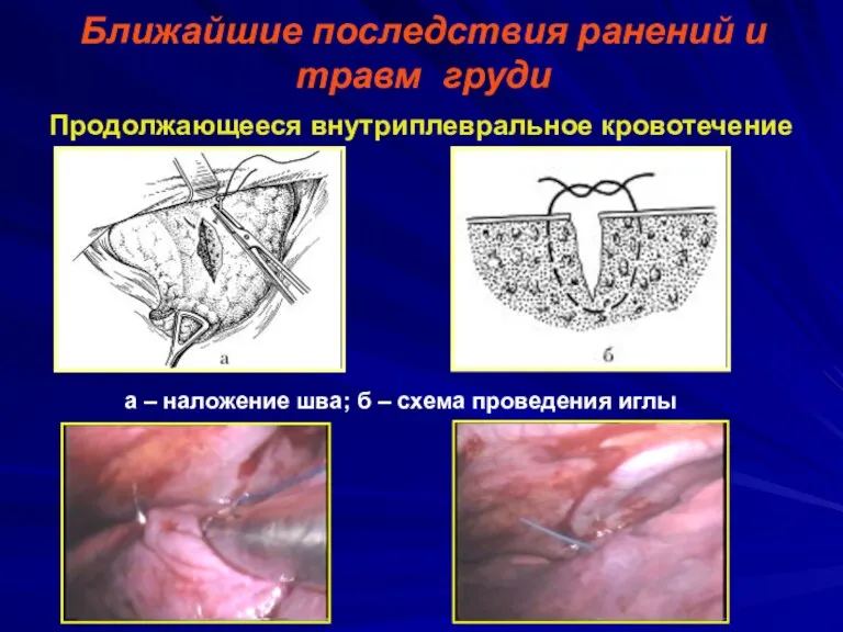Ближайшие последствия ранений и травм груди Продолжающееся внутриплевральное кровотечение а
