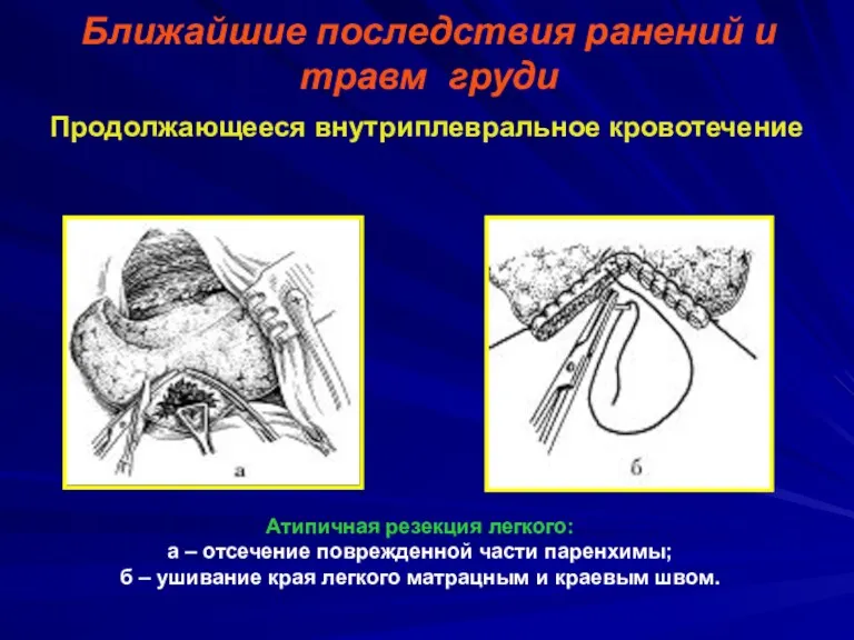 Ближайшие последствия ранений и травм груди Продолжающееся внутриплевральное кровотечение Атипичная