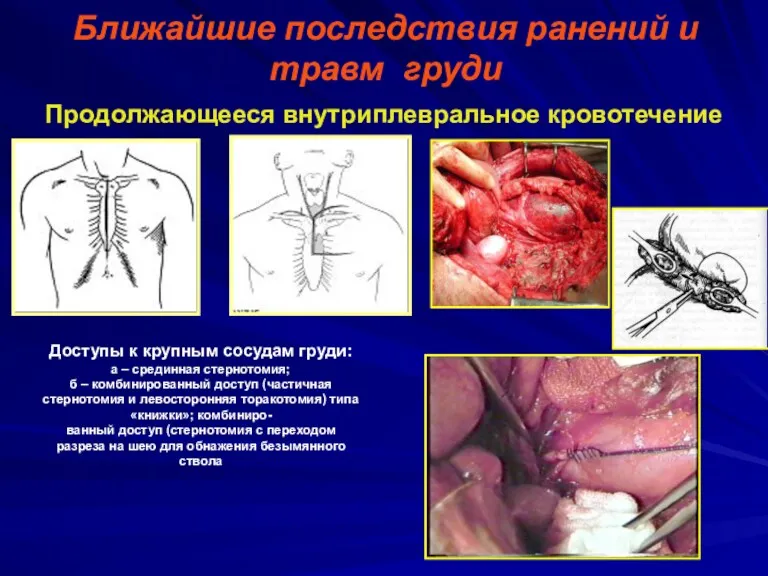 Ближайшие последствия ранений и травм груди Продолжающееся внутриплевральное кровотечение Доступы