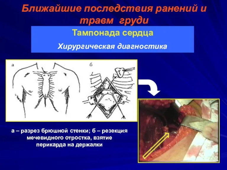 Ближайшие последствия ранений и травм груди Тампонада сердца Хирургическая диагностика