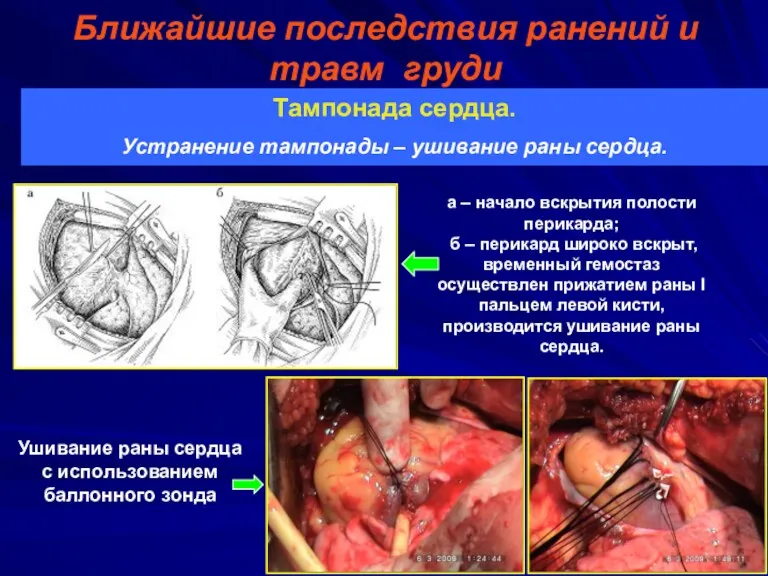 Ближайшие последствия ранений и травм груди Тампонада сердца. Устранение тампонады