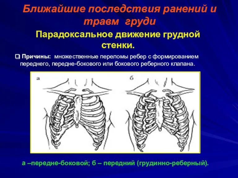 Ближайшие последствия ранений и травм груди Парадоксальное движение грудной стенки.