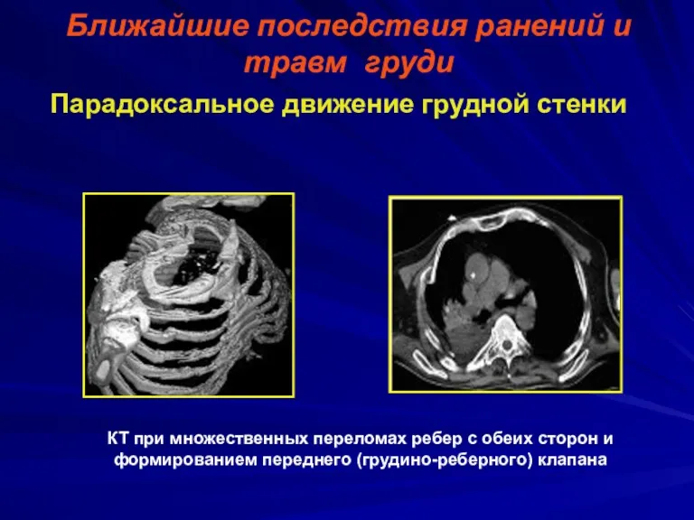 Ближайшие последствия ранений и травм груди Парадоксальное движение грудной стенки