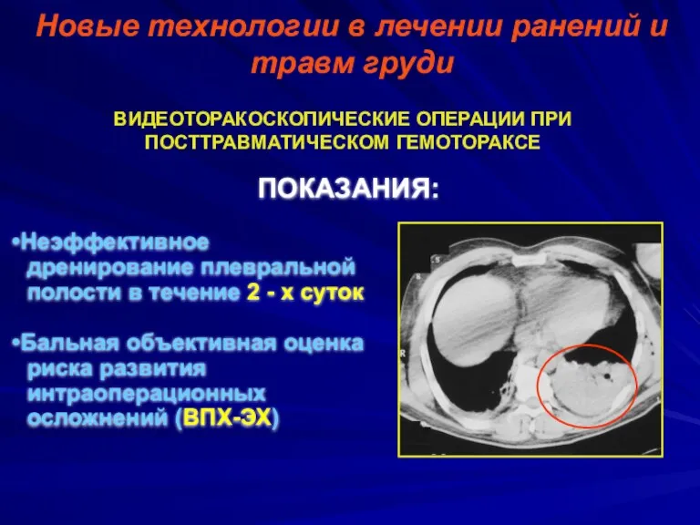 Новые технологии в лечении ранений и травм груди ВИДЕОТОРАКОСКОПИЧЕСКИЕ ОПЕРАЦИИ