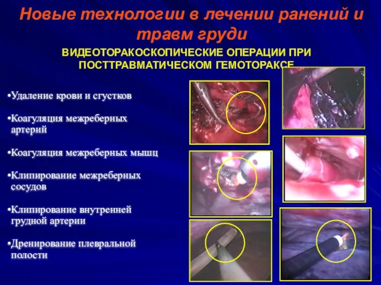 Новые технологии в лечении ранений и травм груди ВИДЕОТОРАКОСКОПИЧЕСКИЕ ОПЕРАЦИИ