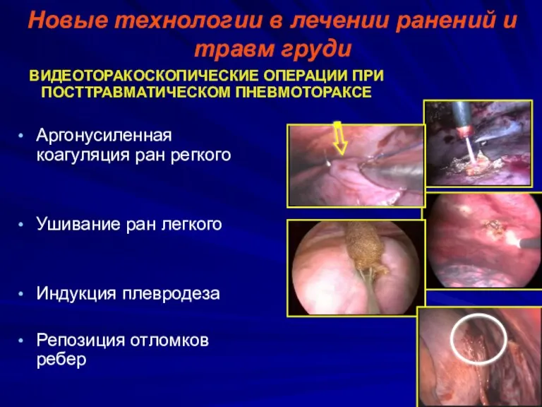 Новые технологии в лечении ранений и травм груди ВИДЕОТОРАКОСКОПИЧЕСКИЕ ОПЕРАЦИИ