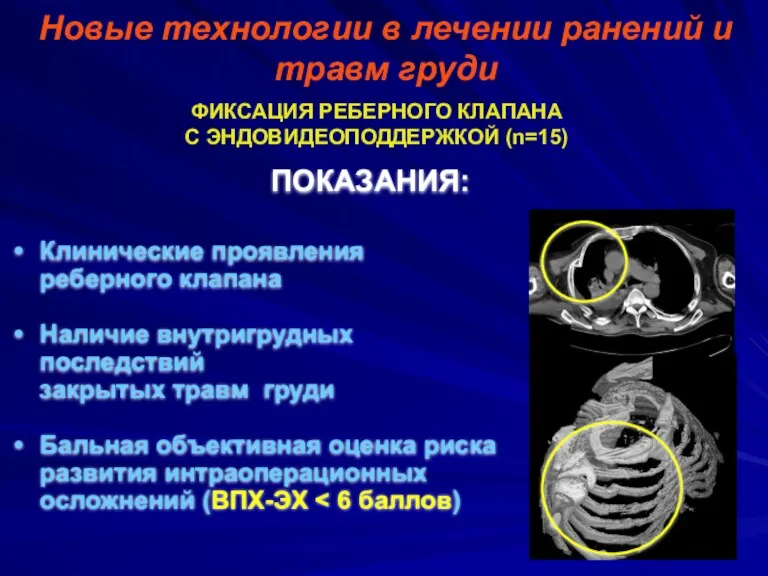 Новые технологии в лечении ранений и травм груди ФИКСАЦИЯ РЕБЕРНОГО