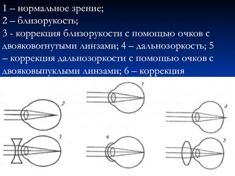 1 – нормальное зрение; 2 – близорукость; 3 - коррекция