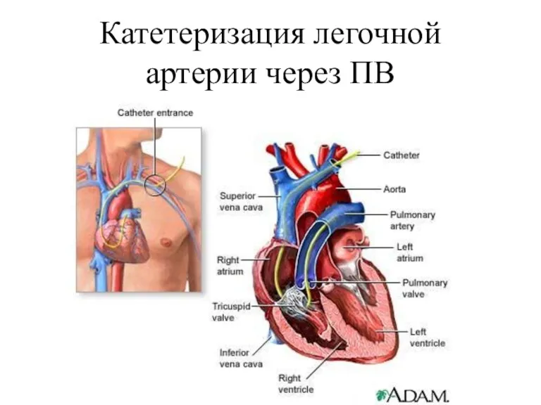 Катетеризация легочной артерии через ПВ