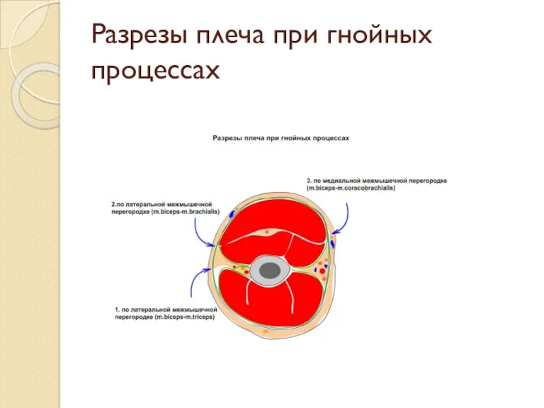 Разрезы плеча при гнойных процессах