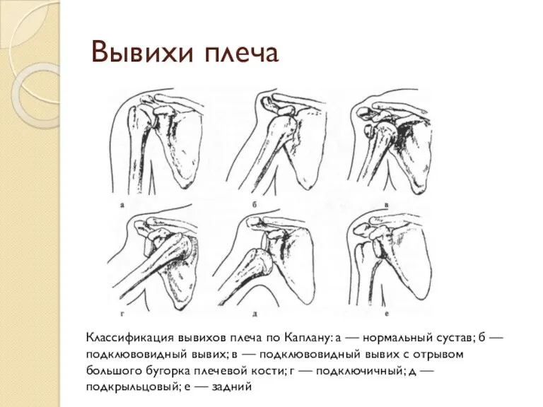 Вывихи плеча Классификация вывихов плеча по Каплану: а — нормальный