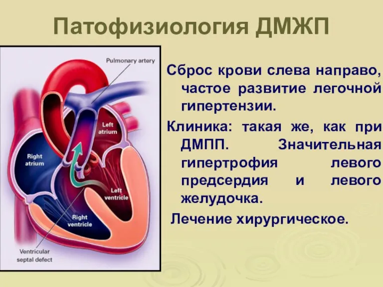 Патофизиология ДМЖП Сброс крови слева направо, частое развитие легочной гипертензии.