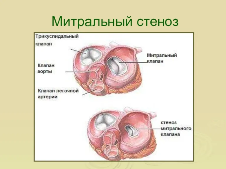 Митральный стеноз