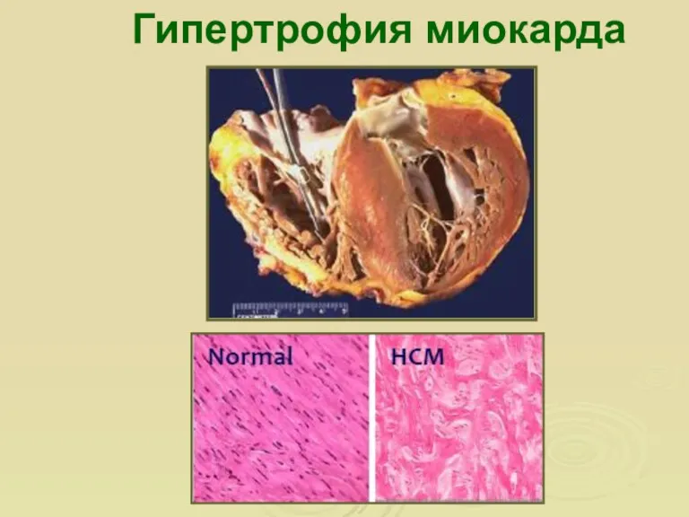 Гипертрофия миокарда