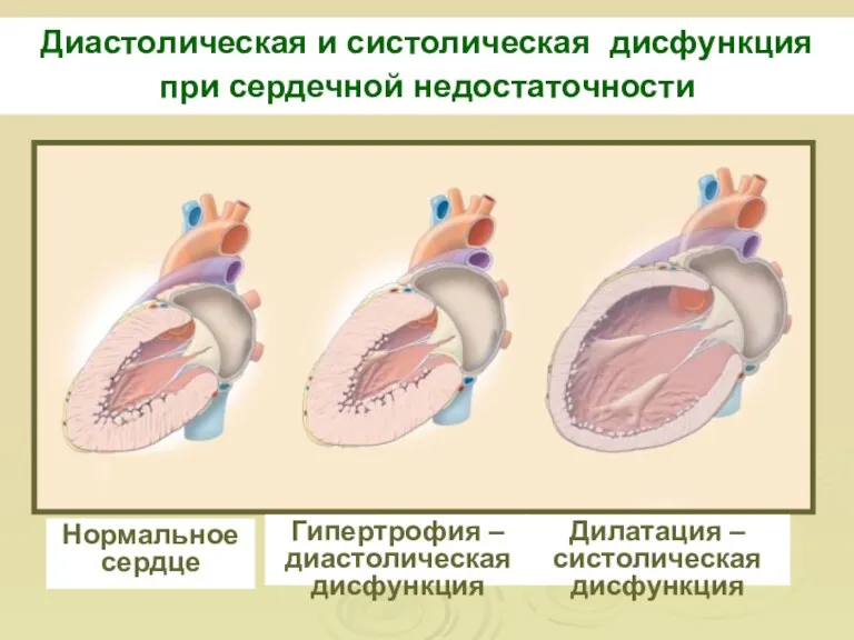 Диастолическая и систолическая дисфункция при сердечной недостаточности Нормальное сердце Гипертрофия