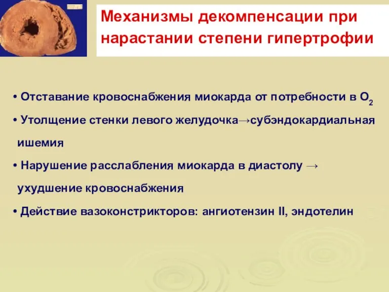 Механизмы декомпенсации при нарастании степени гипертрофии Отставание кровоснабжения миокарда от