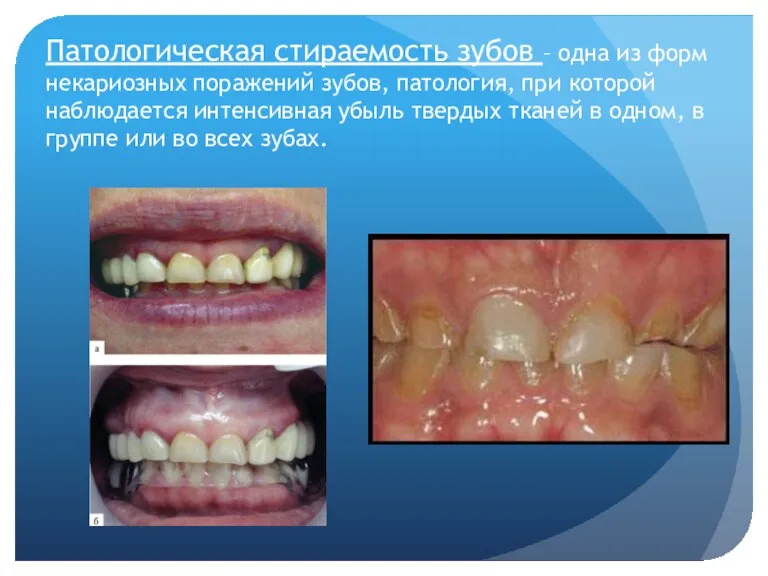 Патологическая стираемость зубов – одна из форм некариозных поражений зубов, патология, при которой