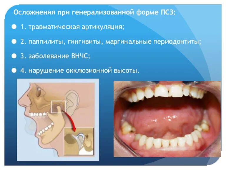 Осложнения при генерализованной форме ПСЗ: 1. травматическая артикуляция; 2. паппилиты,