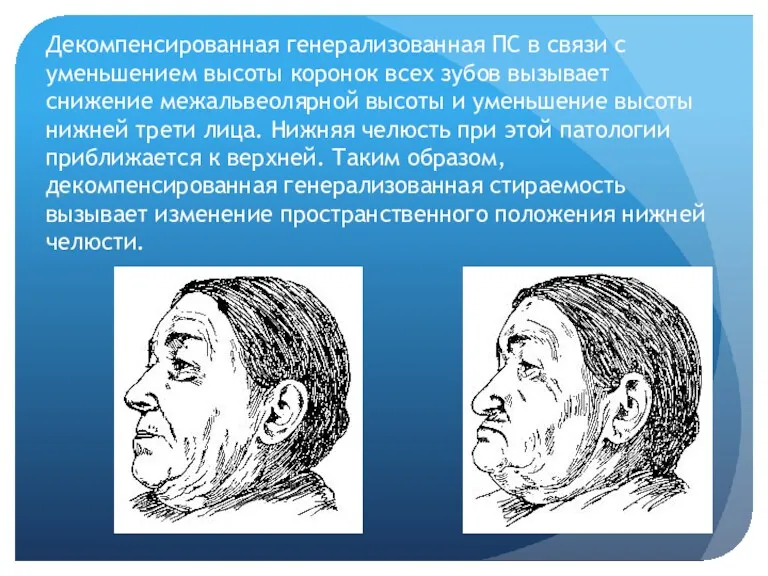 Декомпенсированная генерализованная ПС в связи с уменьшением высоты коронок всех зубов вызывает снижение