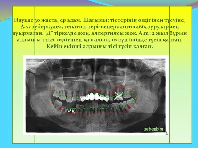 Науқас 30 жаста, ер адам. Шағымы: тістерінің оздігінен түсуіне, А.v: