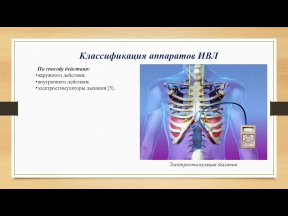 По способу действия: наружного действия; внутреннего действия; электростимуляторы дыхания [5]. Классификация аппаратов ИВЛ Электростимуляция дыхания