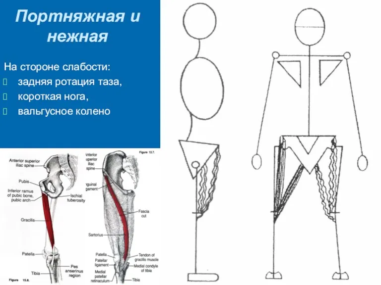 Портняжная и нежная На стороне слабости: задняя ротация таза, короткая нога, вальгусное колено