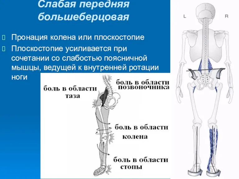 Слабая передняя большеберцовая Пронация колена или плоскостопие Плоскостопие усиливается при