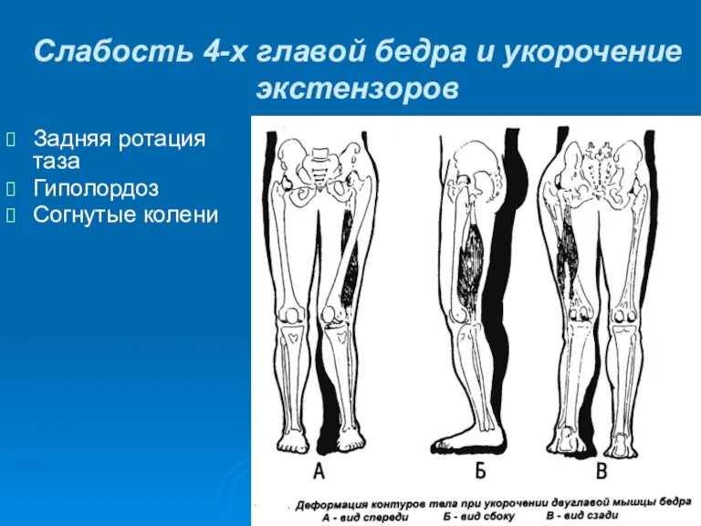 Слабость 4-х главой бедра и укорочение экстензоров Задняя ротация таза Гиполордоз Согнутые колени