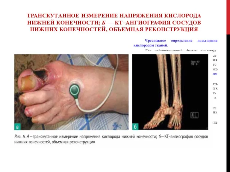 ТРАНСКУТАННОЕ ИЗМЕРЕНИЕ НАПРЯЖЕНИЯ КИСЛОРОДА НИЖНЕЙ КОНЕЧНОСТИ; Б — КТ–АНГИОГРАФИЯ СОСУДОВ