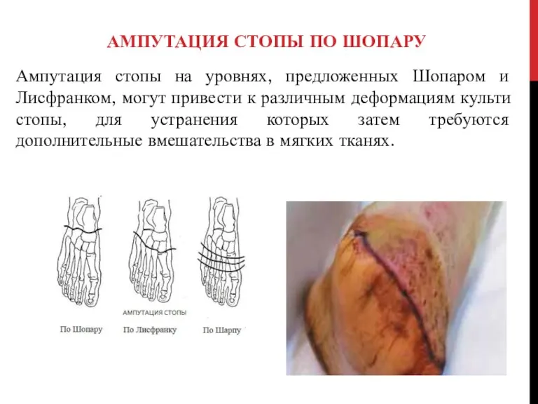 АМПУТАЦИЯ СТОПЫ ПО ШОПАРУ Ампутация стопы на уровнях, предложенных Шопаром