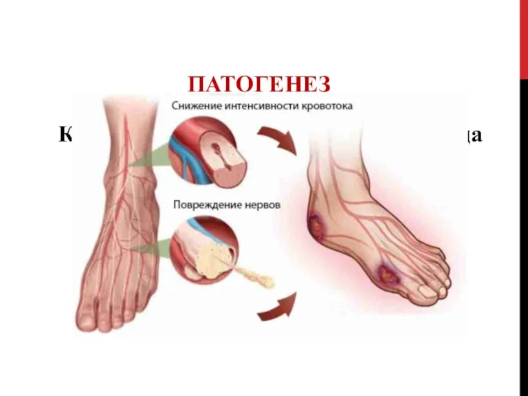 ПАТОГЕНЕЗ Классическая патогенетическая триада СДС включает ишемию, нейропатию и инфекцию.