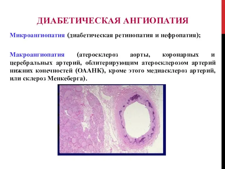 ДИАБЕТИЧЕCКАЯ АНГИОПАТИЯ Микроангиопатия (диабетическая ретинопатия и нефропатия); Макроангиопатия (атеросклероз аорты,