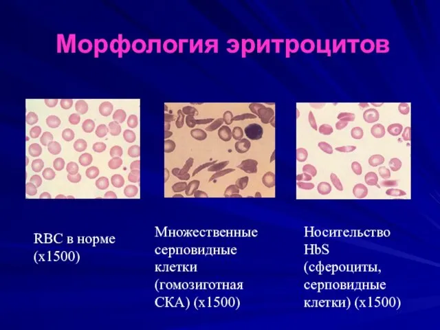 Морфология эритроцитов RBC в норме (х1500) Множественные серповидные клетки (гомозиготная