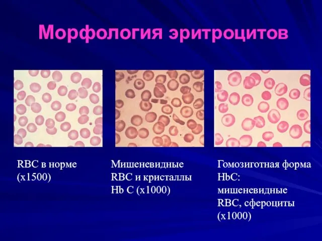 Морфология эритроцитов RBC в норме (х1500) Мишеневидные RBC и кристаллы