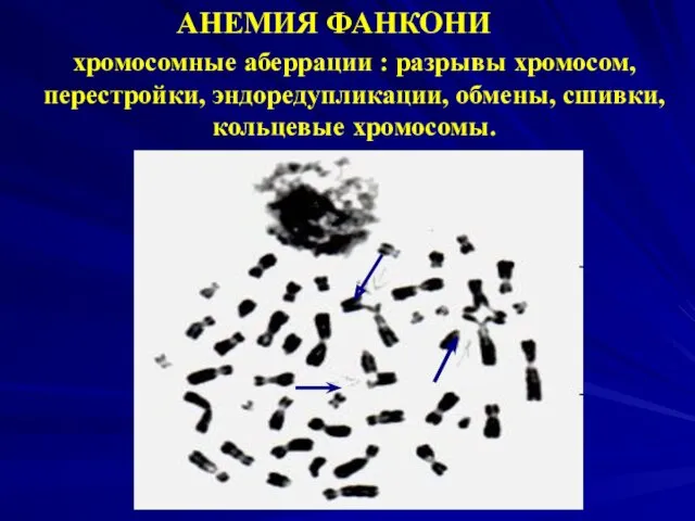 хромосомные аберрации : разрывы хромосом, перестройки, эндоредупликации, обмены, сшивки, кольцевые хромосомы. АНЕМИЯ ФАНКОНИ