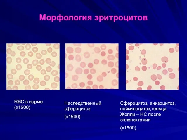 Морфология эритроцитов RBC в норме (х1500) Наследственный сфероцитоз (х1500) Сфероцитоз,