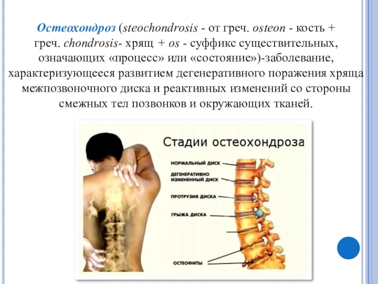 Остеохондроз (steochondrosis - от греч. osteon - кость + греч.