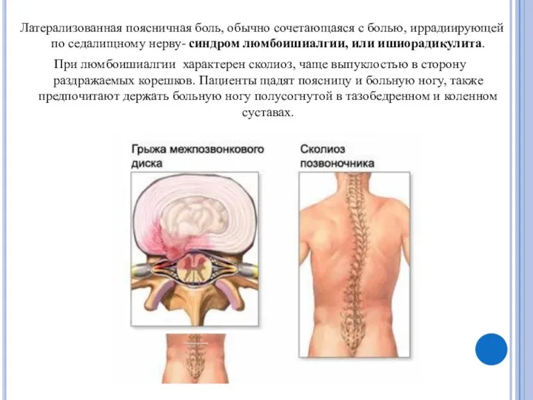 Латерализованная поясничная боль, обычно сочетающаяся с болью, иррадиирующей по седалищному нерву- синдром люмбоишиалгии,