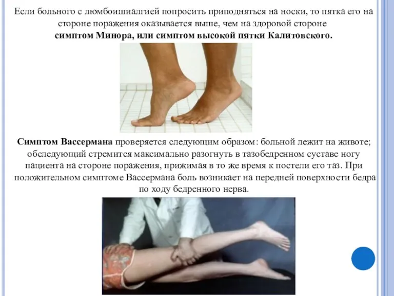 Если больного с люмбоишиалгией попросить приподняться на носки, то пятка его на стороне