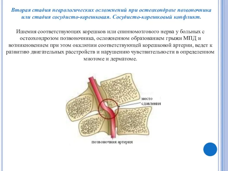 Ишемия соответствующих корешков или спинномозгового нерва у больных с остеохондрозом
