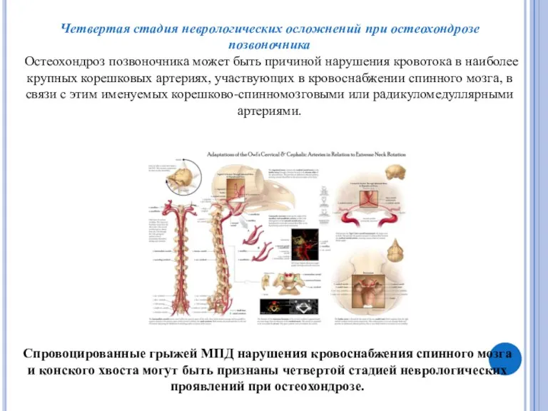 Четвертая стадия неврологических осложнений при остеохондрозе позвоночника Остеохондроз позвоночника может