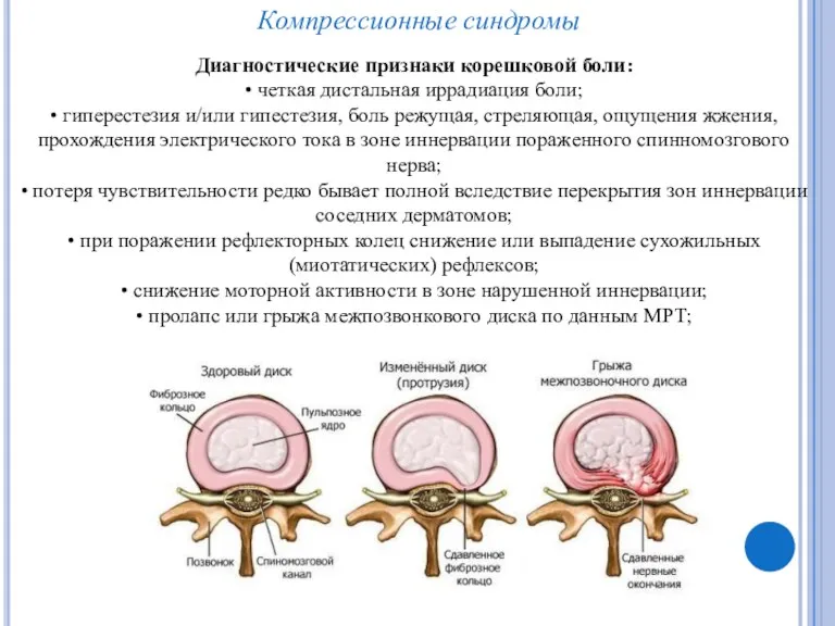 Компрессионные синдромы Диагностические признаки корешковой боли: • четкая дистальная иррадиация боли; • гиперестезия