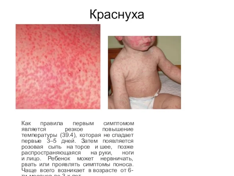 Краснуха Как правила первым симптомом является резкое повышение температуры (39.4),