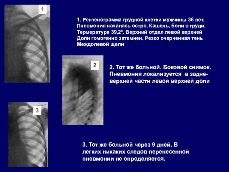 1. Рентенограмма грудной клетки мужчины 36 лет. Пневмония началась остро.