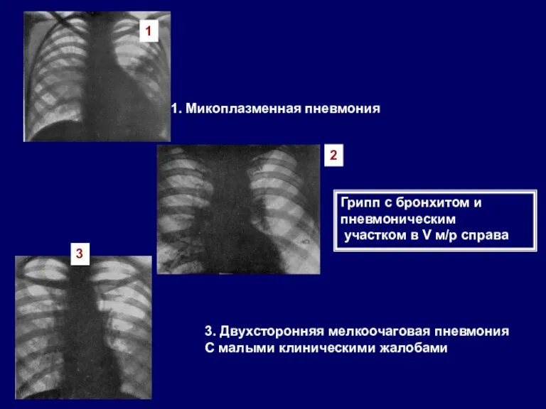 1. Микоплазменная пневмония 3. Двухсторонняя мелкоочаговая пневмония С малыми клиническими