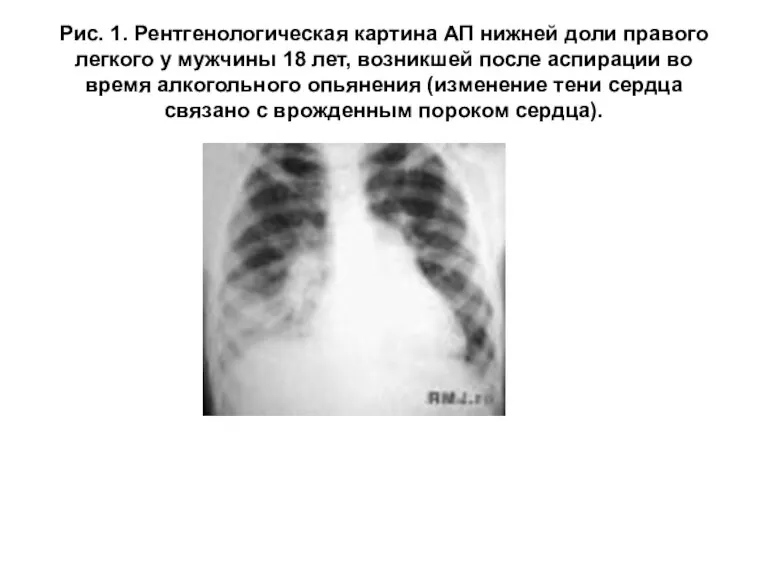 Рис. 1. Рентгенологическая картина АП нижней доли правого легкого у